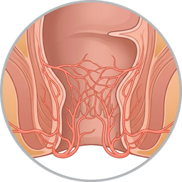 Hemorrhoid Artery Embolization